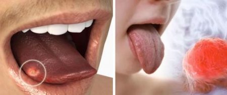 Предупреждение о раке языка: Названы семь неочевидных симптомов у курильщик ...